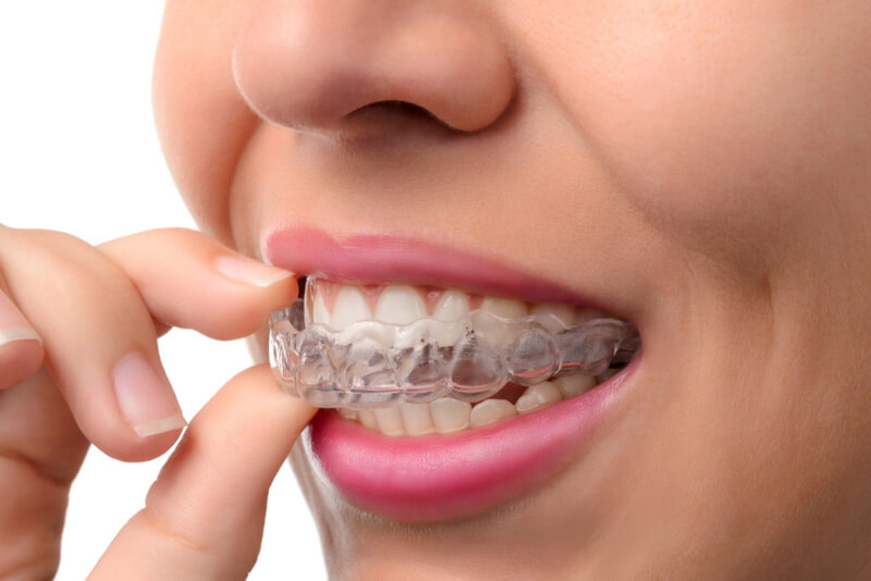 orthodontic mouth guard